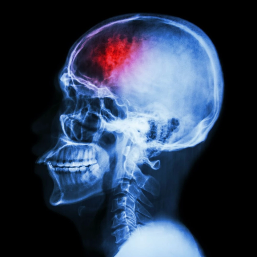 Често срещани черепно-мозъчни травми